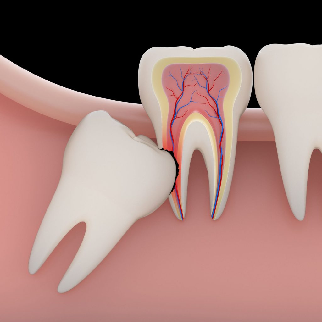 wisdom tooth extraction in Singapore